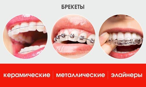 Виды брекетов стоматология #АЛЬФАДЕНТ116
